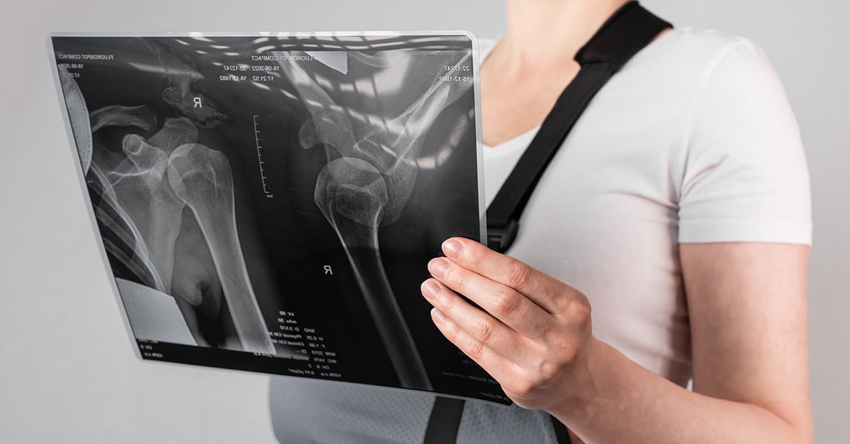x-rays after car accident